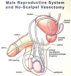 after vasectomy